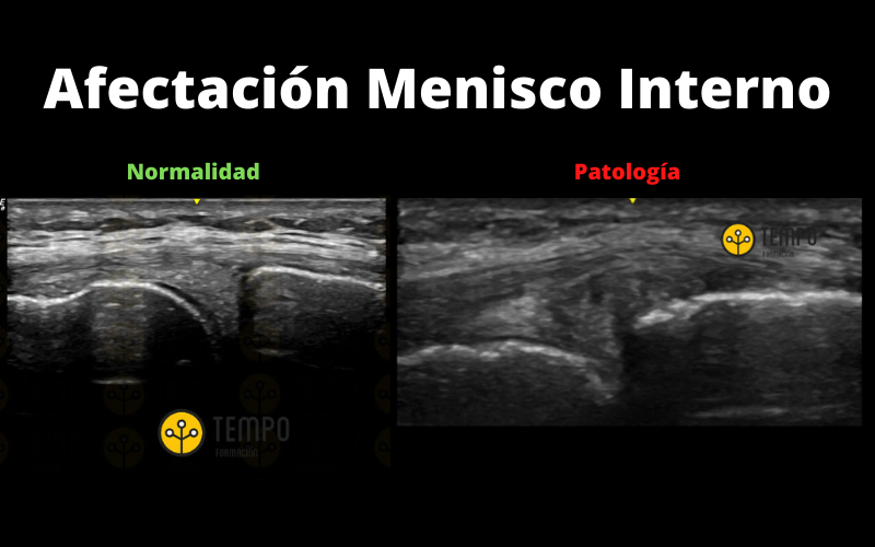 Antología Aleta Capacidad Resonancia Magnetica De Rodilla Meniscos ...